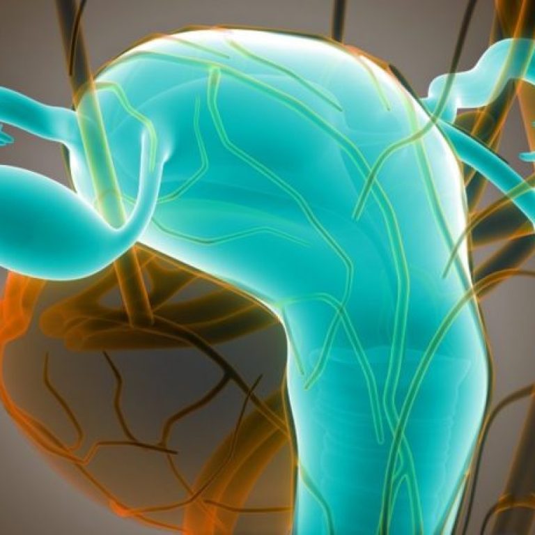 polip-intrauterin-770x460